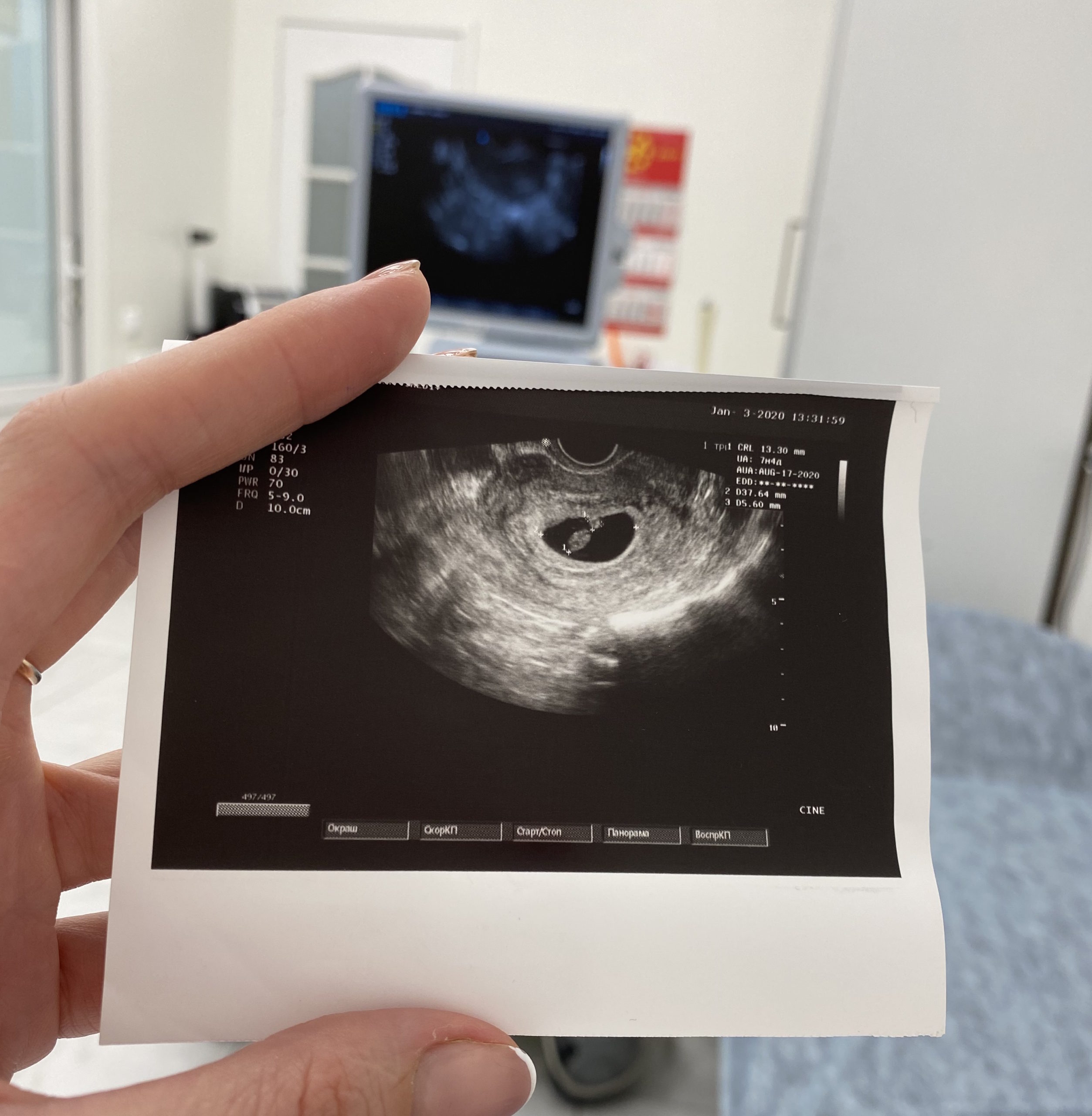 Пренатальный комбинированный СКРИНИНГ 1-го триместра: 12 (11-13,6) недель беременности OSCAR
